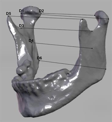 Comparison of the Accuracy and Clinical Parameters of Patient-Specific and Conventionally Bended Plates for Mandibular Reconstruction